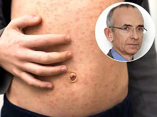 Los Angeles Child Dies from Rare Measles Complication Contracted Before Vaccine Eligibility