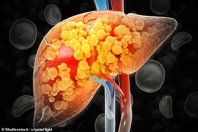 Breakthrough in Liver Disease Treatment: Common Medications Show Promise in Reversing MASLD