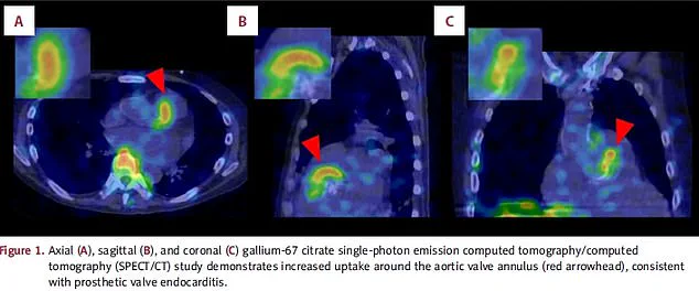 Exclusive Insight: Rare Case Reveals Hidden Dangers of Common Skin Bacteria
