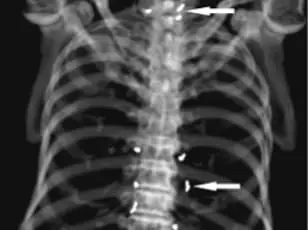 Hidden Risks of Gold Thread Acupuncture: Expert Warnings Highlight Medical Transparency and Patient Safety Concerns