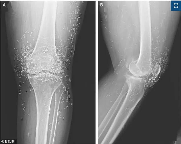 Hidden Risks of Gold Thread Acupuncture: Expert Warnings Highlight Medical Transparency and Patient Safety Concerns