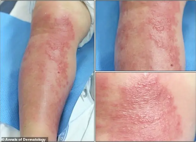 Hidden Risks of Gold Thread Acupuncture: Expert Warnings Highlight Medical Transparency and Patient Safety Concerns