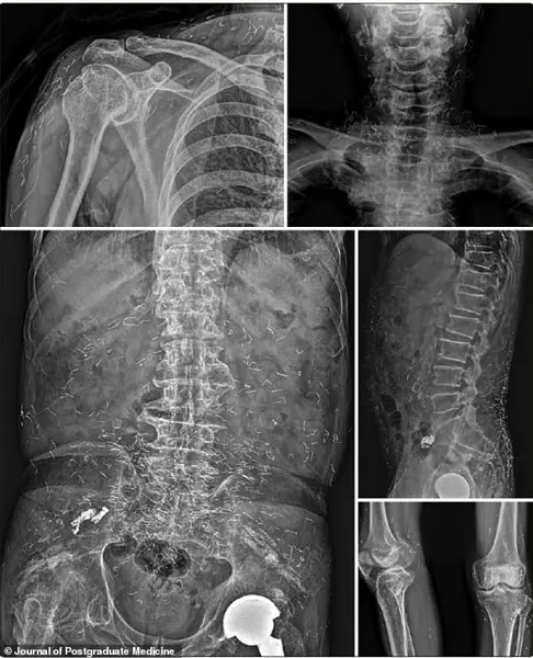 Hidden Risks of Gold Thread Acupuncture: Expert Warnings Highlight Medical Transparency and Patient Safety Concerns