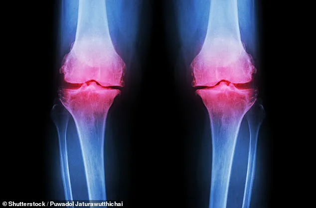 Silent Epidemic: Knee Pain Signals a Global Health Crisis with Limited Treatment