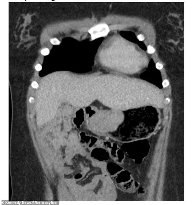 Bella Bayliss's Medical Emergency: Unaddressed Symptoms at Gloucestershire Royal Hospital