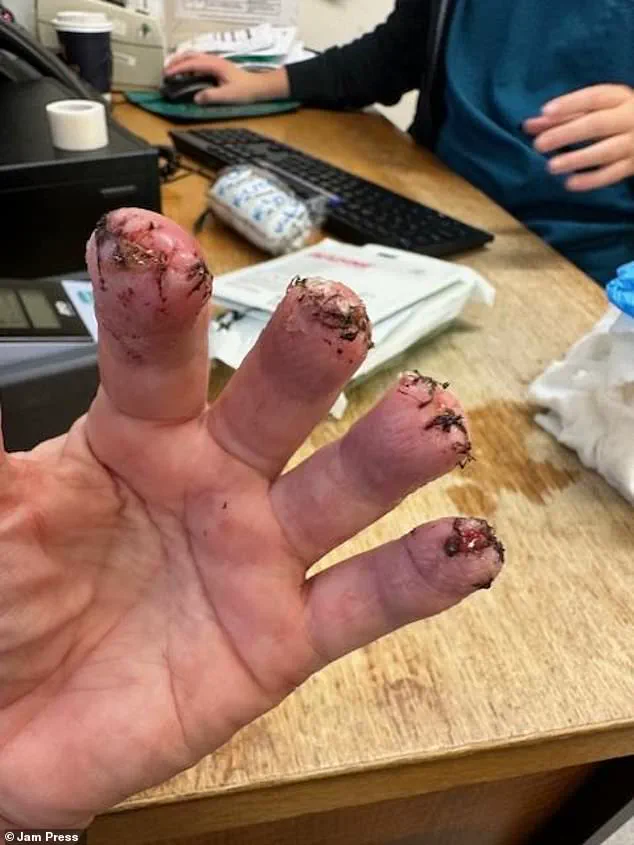 Misdiagnosis Leads to Harrowing Situation for Woman with Kidney Stone Symptoms