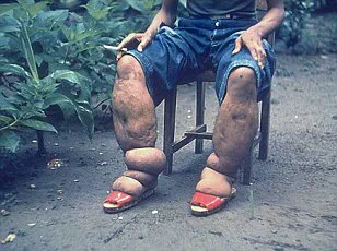 Rising Concerns Over Kissing Bugs and Chagas Disease as Parasite-Infected Insects Cross the US-Mexico Border