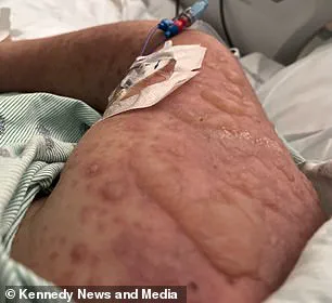 Emily McAllister's Ordeal: A Rare Side Effect of Lamotrigine Leads to Devastating Skin Loss