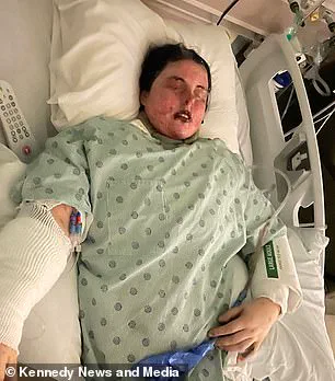 Emily McAllister's Ordeal: A Rare Side Effect of Lamotrigine Leads to Devastating Skin Loss