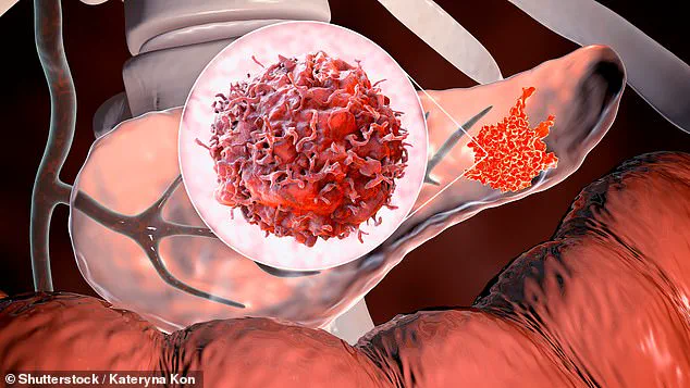 Groundbreaking Blood Test for Early Pancreatic Cancer Detection Could Improve Survival Rates