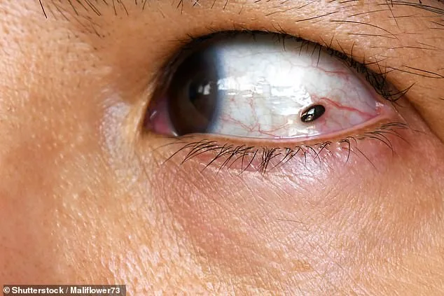 A Freckle's Silent Warning: Laura Graham-Claire's Unseen Battle with Eye Cancer