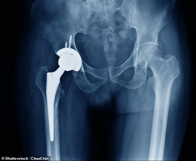 NHS Crisis: Bone Cement Shortage Threatens Thousands of Hip and Knee Replacements