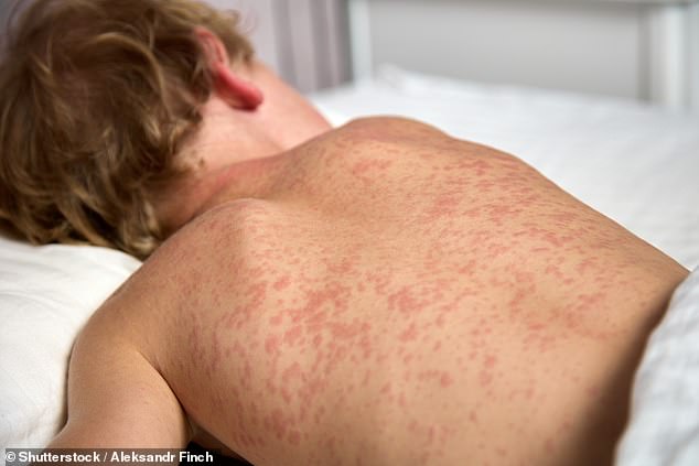 Utah High Schools Alert Over Measles Outbreak: Unvaccinated Student Puts Thousands at 90% Infection Risk