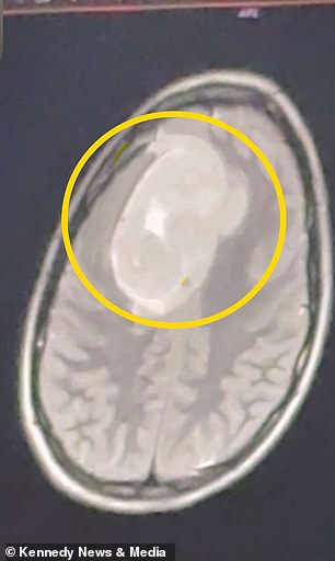 Benign Brain Tumor Shocks 21-Year-Old After Misdiagnosis of Stress Headaches