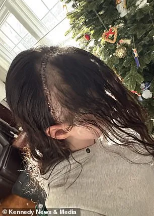 Benign Brain Tumor Shocks 21-Year-Old After Misdiagnosis of Stress Headaches