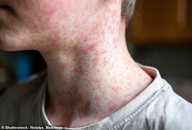 Measles Resurgence: US Cases Near 1,000 in Two Months, South Carolina at Epicenter