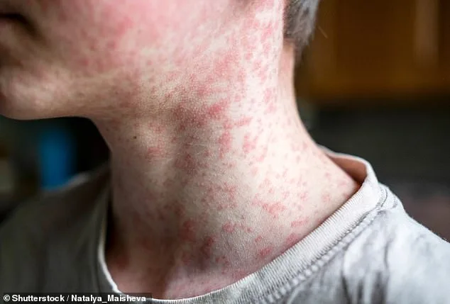 Measles Resurgence: US Cases Near 1,000 in Two Months, South Carolina at Epicenter