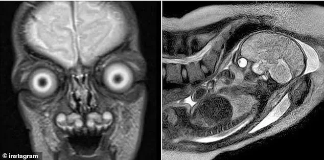Haunting Images, Life-Saving Insights: The Fetal MRI Debate