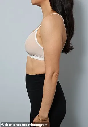 A Quiet Revolution: Natural Breast Aesthetics Reshape Beauty Standards