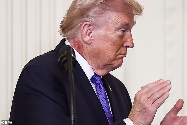 Donald Trump's Neck Rash Sparks Speculation, Experts Suggest Actinic Keratoses as Likely Culprit