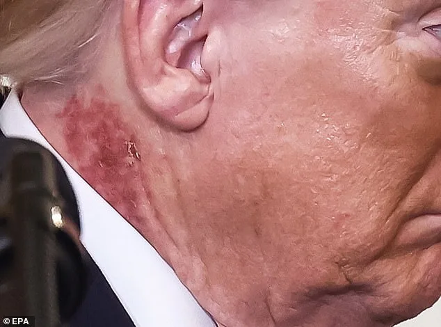 Donald Trump's Neck Rash Sparks Speculation, Experts Suggest Actinic Keratoses as Likely Culprit
