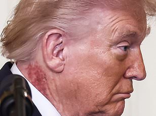 Donald Trump's Neck Rash Sparks Speculation, Experts Suggest Actinic Keratoses as Likely Culprit