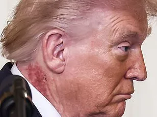 Donald Trump's Neck Rash Sparks Speculation, Experts Suggest Actinic Keratoses as Likely Culprit