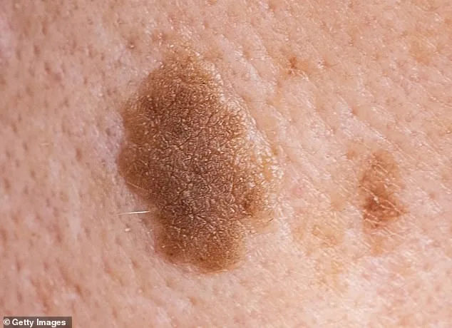 Donald Trump's Neck Rash Sparks Speculation, Experts Suggest Actinic Keratoses as Likely Culprit