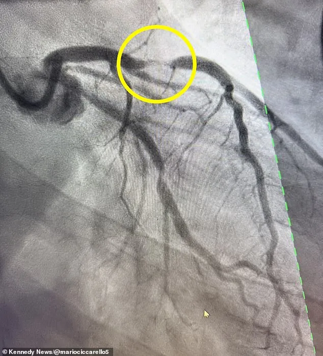 Fit Florida Man Survives Near-Fatal Heart Attack After Mistaking Symptoms for Spicy Food Indigestion