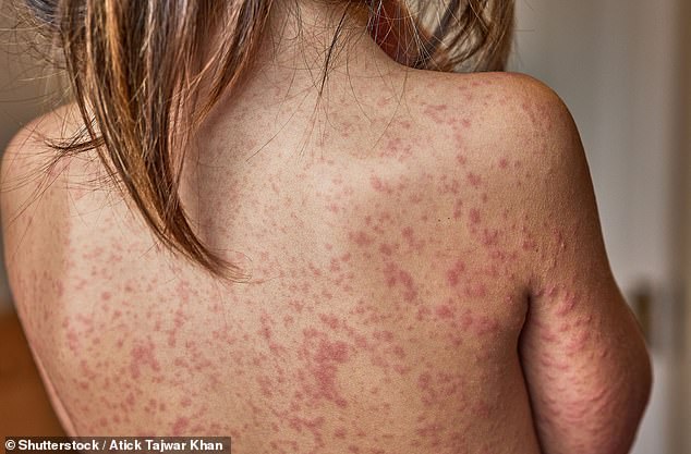 London Schools Consider Banning Unvaccinated Students as Measles Outbreak Escalates