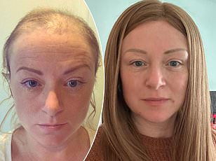 Grey Hair May Act as Early Warning System for Melanoma, Study Suggests