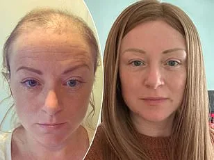 Grey Hair May Act as Early Warning System for Melanoma, Study Suggests