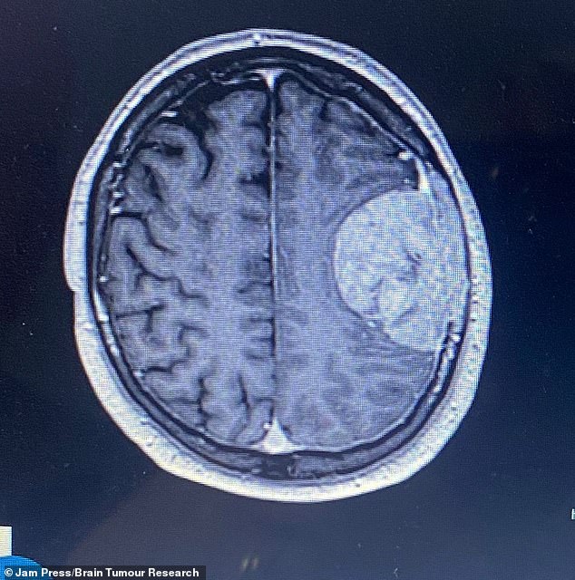 A 62-Year-Old Man's Sudden Illness Reveals Hidden Brain Tumor
