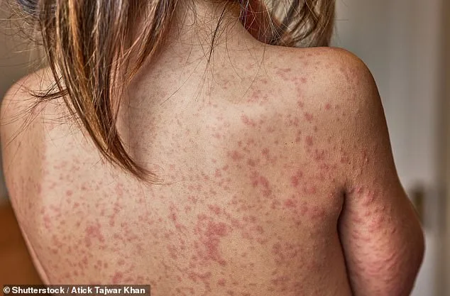 London Measles Outbreak Sparks Debate Over School Exclusions and Mandatory Vaccinations
