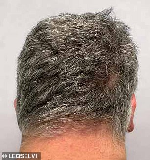 UK MHRA Approves Leqselvi, Offering New Hope for Patients with Severe Alopecia Areata