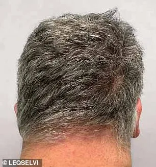 UK MHRA Approves Leqselvi, Offering New Hope for Patients with Severe Alopecia Areata