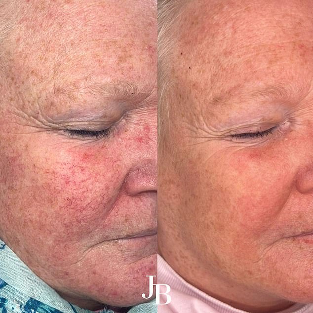 Celebrity-Endorsed BBL HEROic Laser Therapy Shows Promise as Breakthrough Treatment for Rosacea