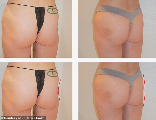 Scarlett James' Life-Changing Transformation with Cadaver Fat Injection