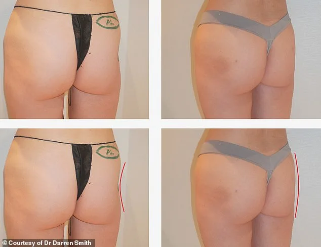 Scarlett James' Life-Changing Transformation with Cadaver Fat Injection