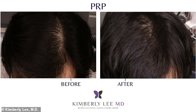 PRP Therapy Offers Non-Invasive Hair Loss Solution Without Surgery or High Costs