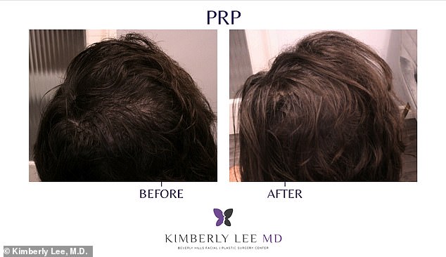 PRP Therapy Offers Non-Invasive Hair Loss Solution Without Surgery or High Costs