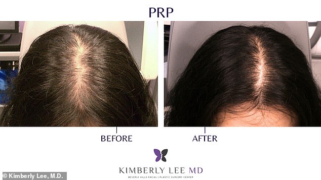 PRP Therapy Offers Non-Invasive Hair Loss Solution Without Surgery or High Costs