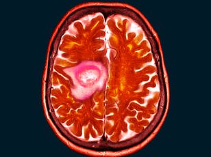 From Mislabeled Mascara to Life-Altering Diagnosis: A Mother's Journey with a Rare Eye Tumor