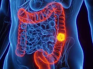 Bowel Cancer Surge Among Young Adults: A Growing Global Health Crisis