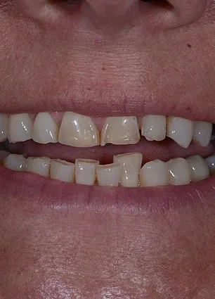 Aging Teeth and the Confidence Crisis: Why Britons Hide Their Smiles