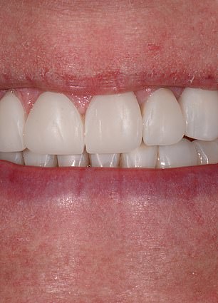 Aging Teeth and the Confidence Crisis: Why Britons Hide Their Smiles