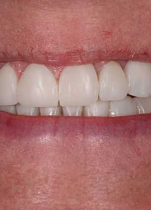 Aging Teeth and the Confidence Crisis: Why Britons Hide Their Smiles