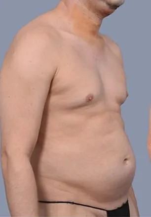 Men's Liposuction Boom: Frank Hoyle's $23k Journey