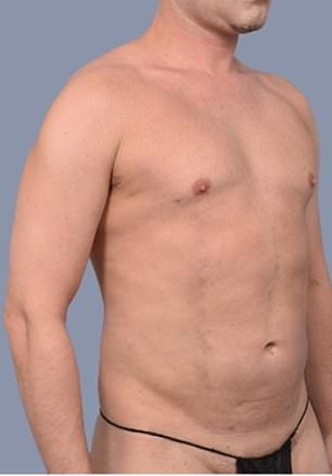Men's Liposuction Boom: Frank Hoyle's $23k Journey