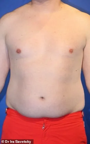 Men's Liposuction Boom: Frank Hoyle's $23k Journey